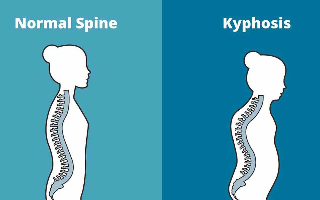 Thoracic Kyphosis Symptoms