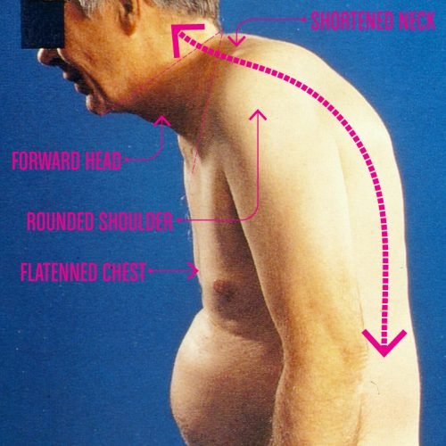 DissapearedNeckRoundedShoulder