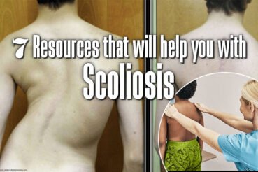 7-Resources-that-will-help-you-with-Scoliosis