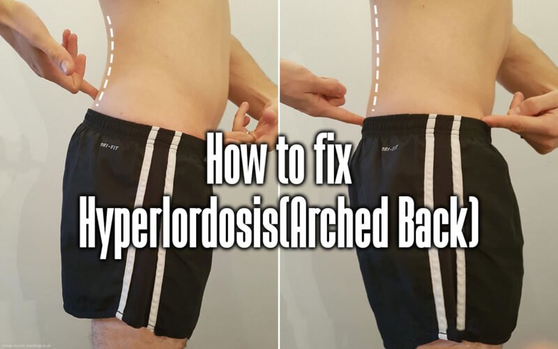 How to fix Hyperlordosis(Arched Back) Your Body Posture