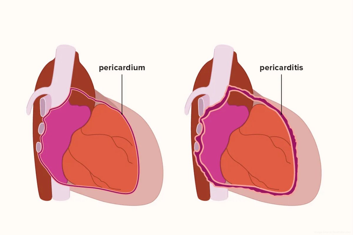 2 -Pericarditis