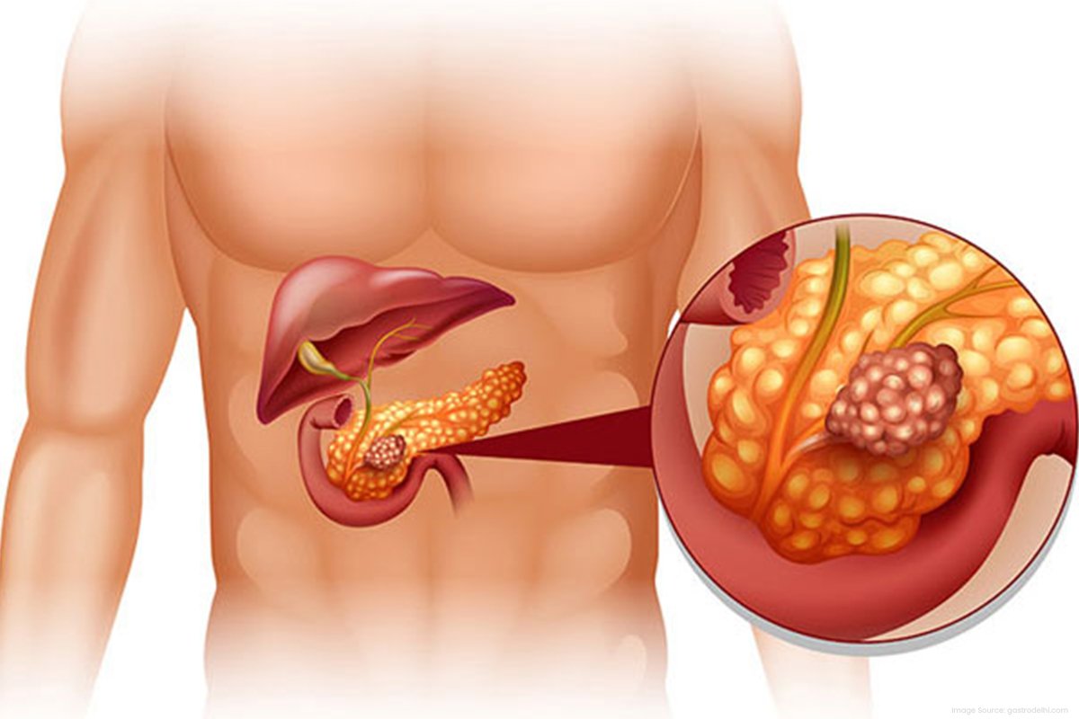4 -Pancreatitis