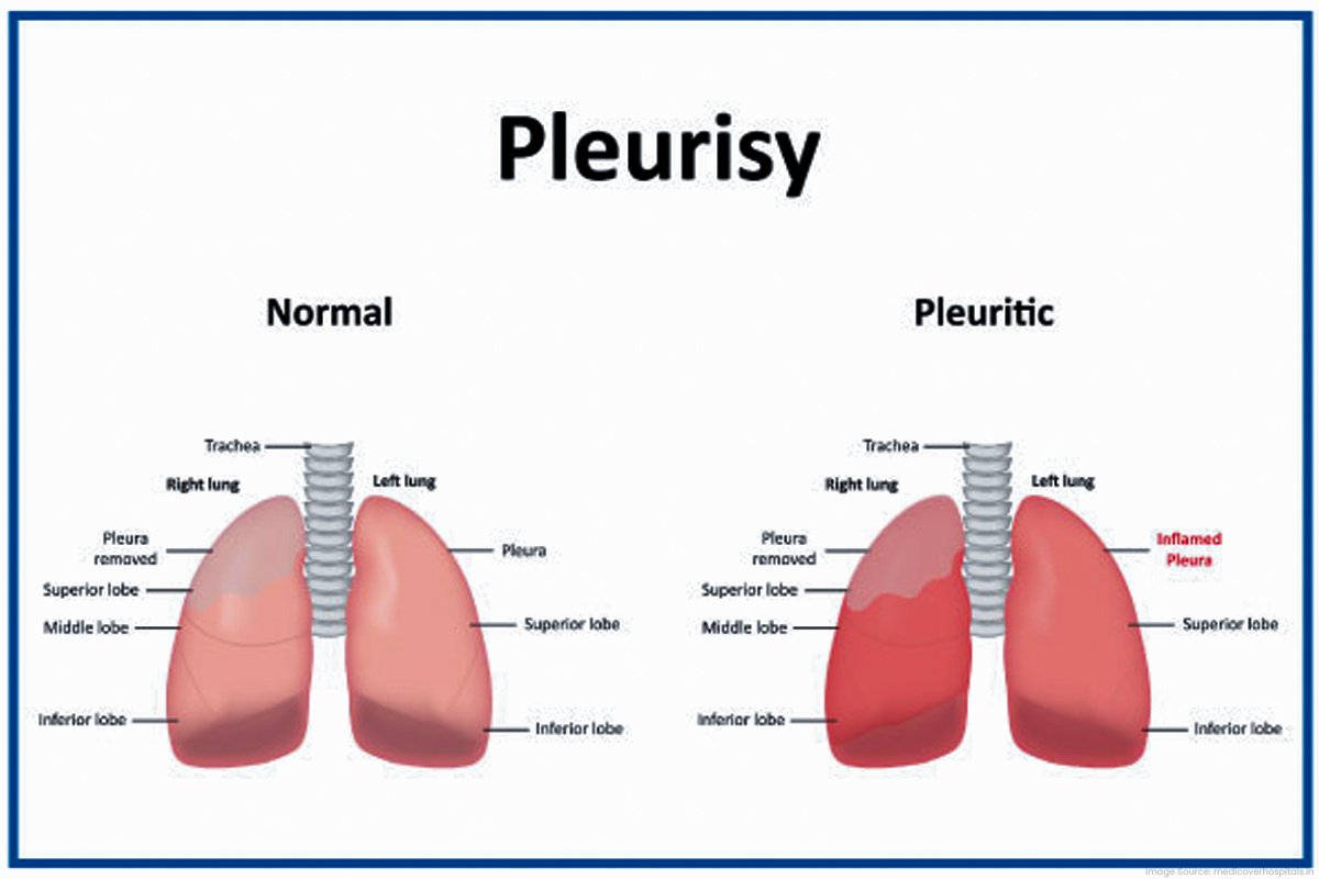 6 -Pleurisy