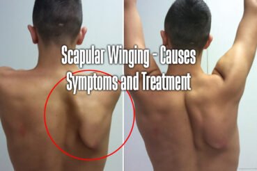 scapular-winging-causes-symptoms-and-treatment