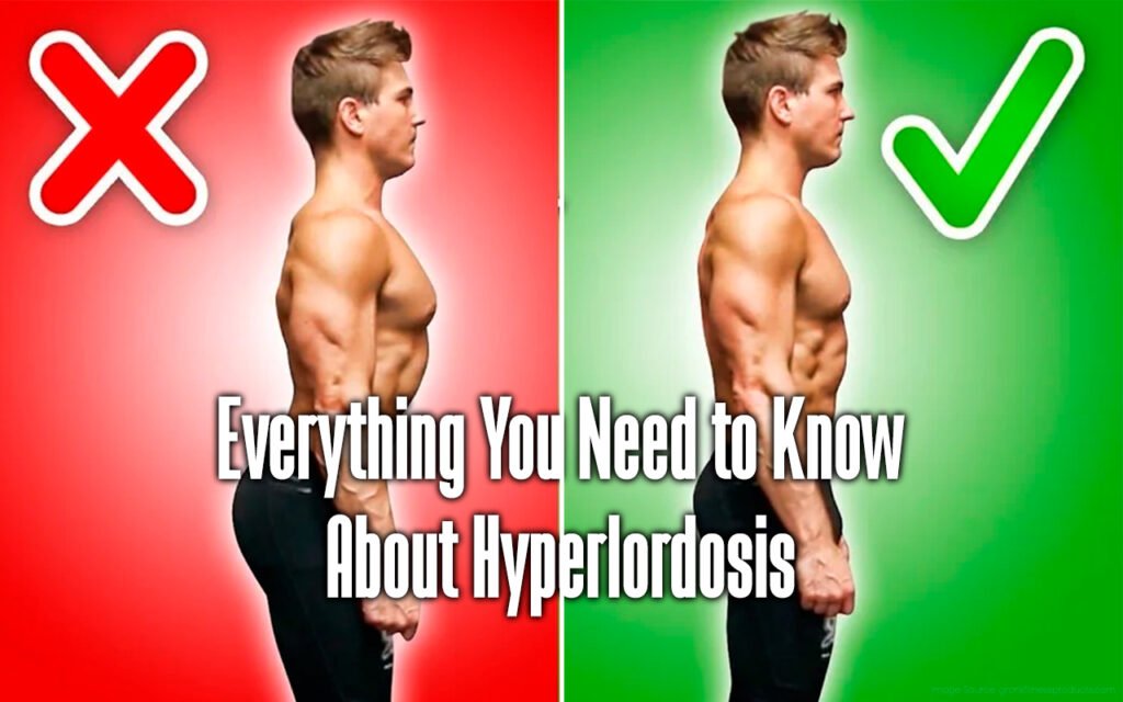 how-to-fix-hyperlordosis