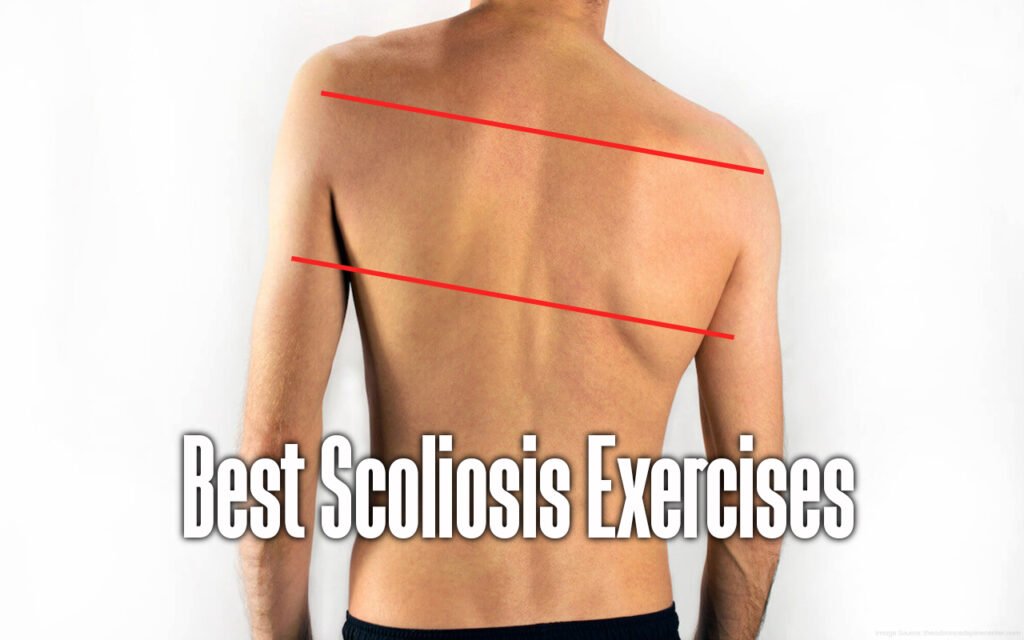 scoliosis-exercises