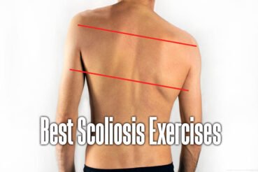 scoliosis-exercises