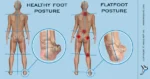 09 17 2017 How Flatfoot Effect Body Posture 1200x 1 600x600