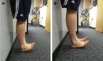 A-B-Heel-rocker-test-Often-the-injured-ankle-lags-behind-the-healthy-ankle-because